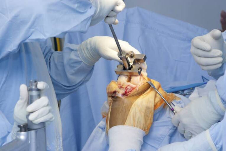 cirurgia de artrose de joelho