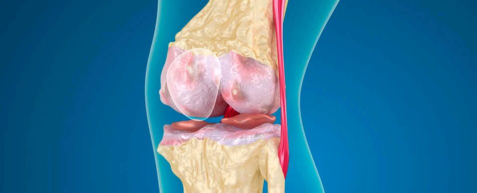 artrose do joelho como causa de dor