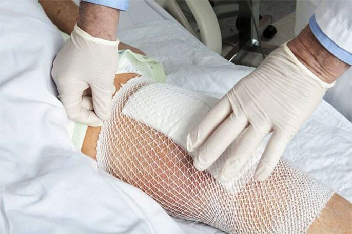 Compressa terapêutica para artrose da articulação do joelho