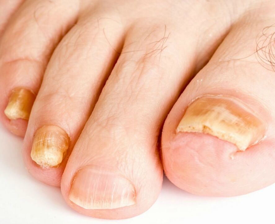 fungo nas unhas