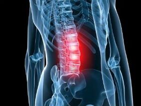 Osteocondrose da coluna lombar
