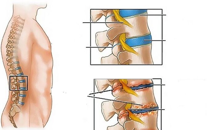 Osteocondrose da região lombar