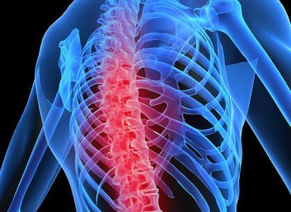 osteocondrose da coluna torácica