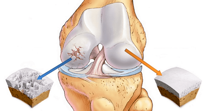 cartilagem saudável e cartilagem afetada por artrose