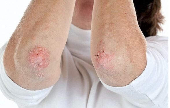Pessoas com psoríase são suscetíveis à artrite psoriática