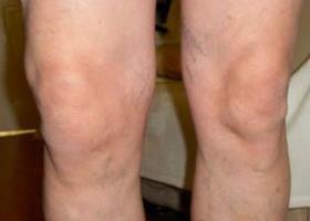 sintomas de joelho