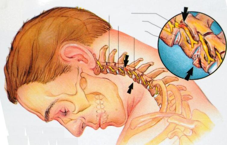 o que acontece com a osteocondrose cervical