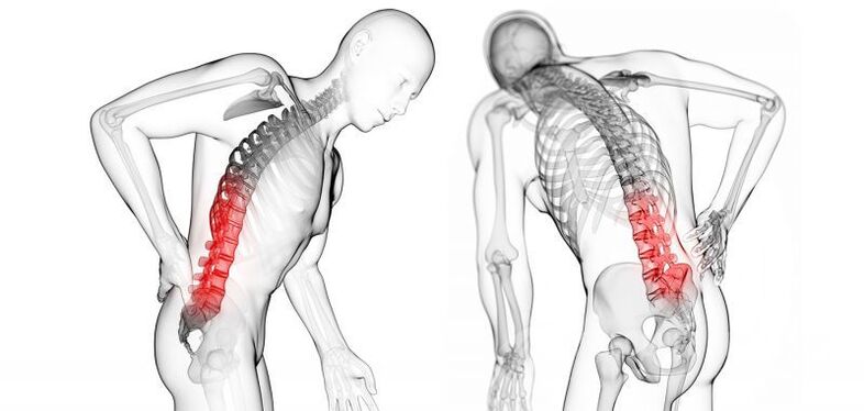 complicações com osteocondrose cervical